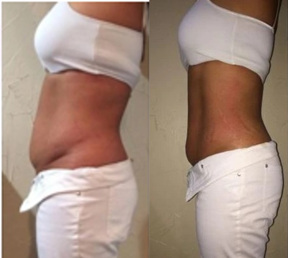FitSlim 3 em 1 - Redutor de Medidas + Cinta Modeladora Efeito Silicone