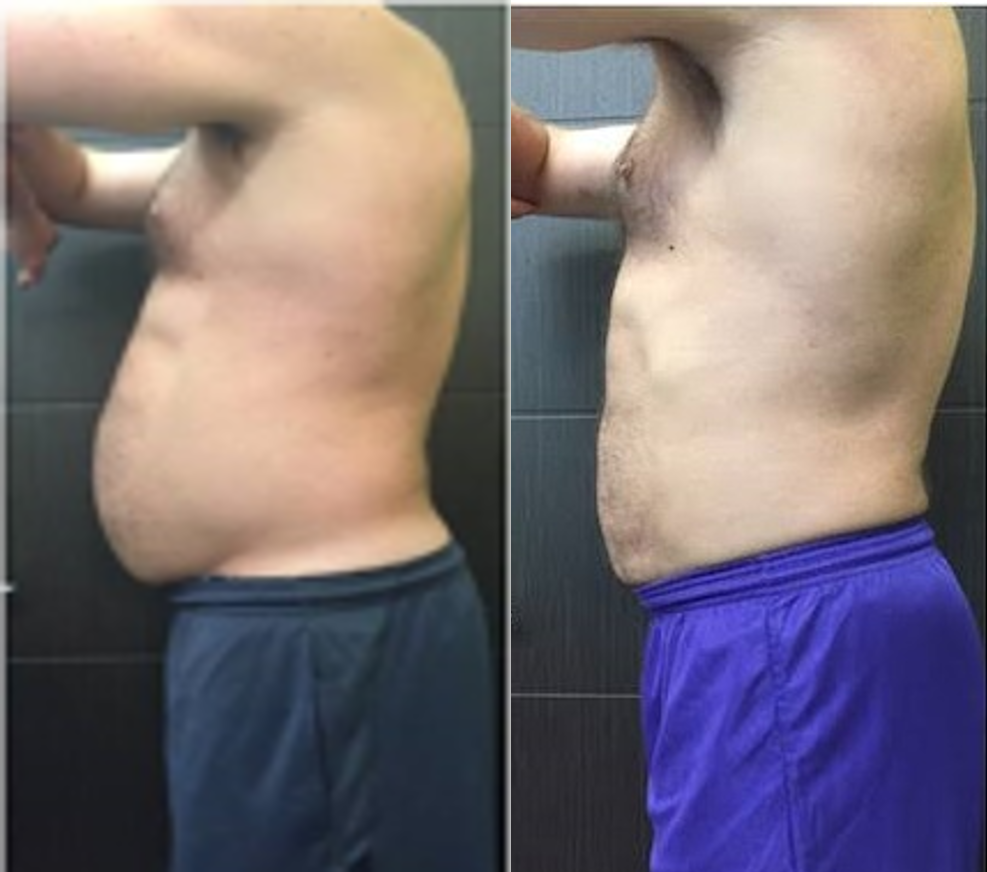 FitSlim 3 em 1 - Redutor de Medidas + Cinta Modeladora Efeito Silicone