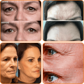 Collagen Skin Botox™ - Máscara de Colágeno Que Revitaliza Pele e Rugas [ATIVOS DO BOTOX] +BRINDE